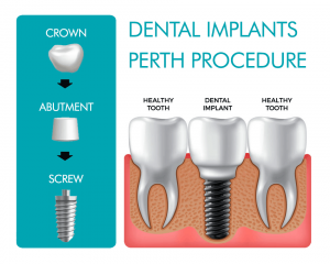 dental implant specialist
