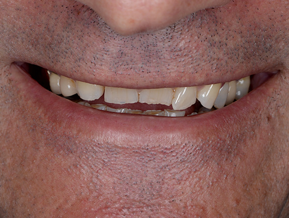 Mid Dental Veneer Process Step 1