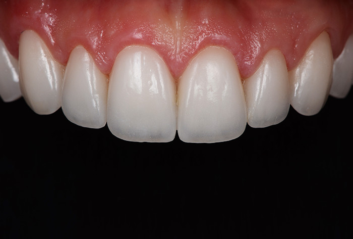 Mid Dental Veneer Image 3