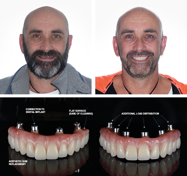 Full mouth dental implants Perth