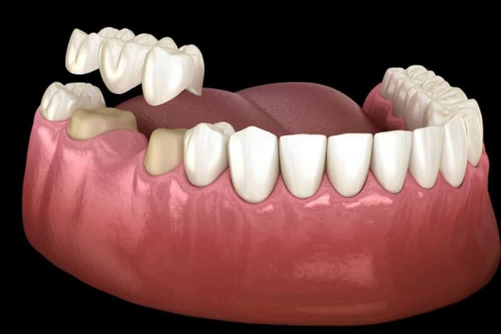 Dental Bridges Procedure 