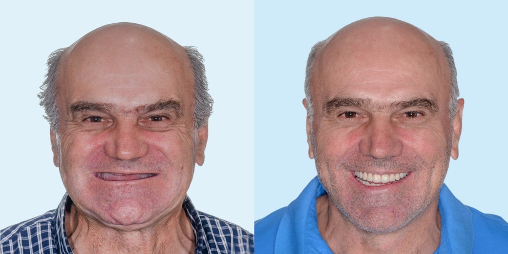 Dental Implants for Seniors