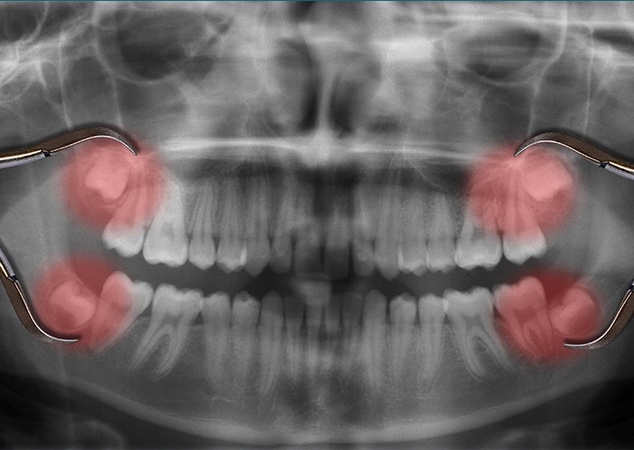 Wisdom Teeth removal perth