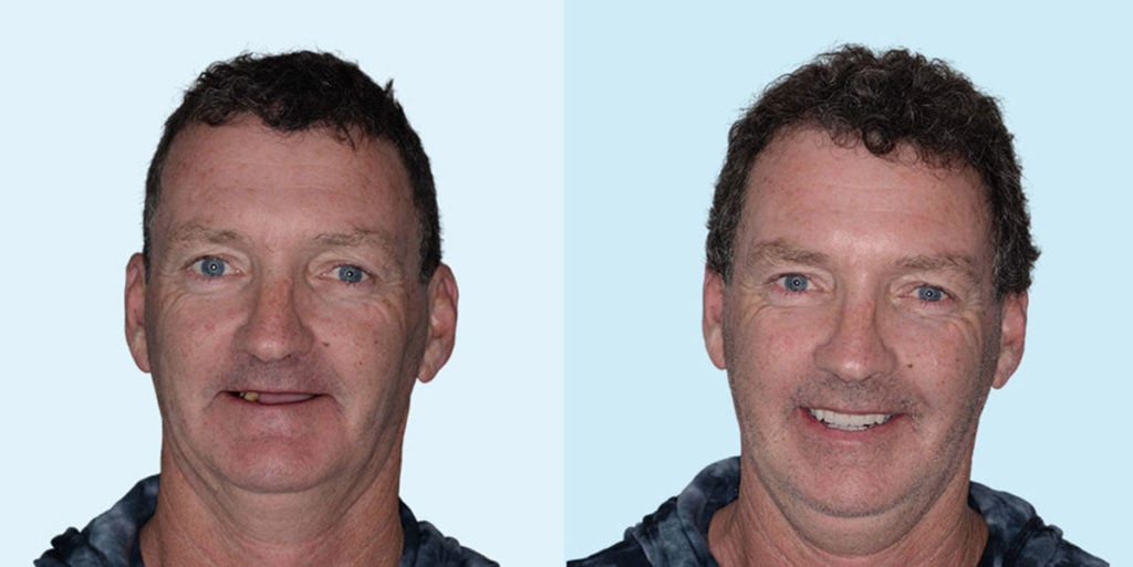 My Implant Dentist Before and After