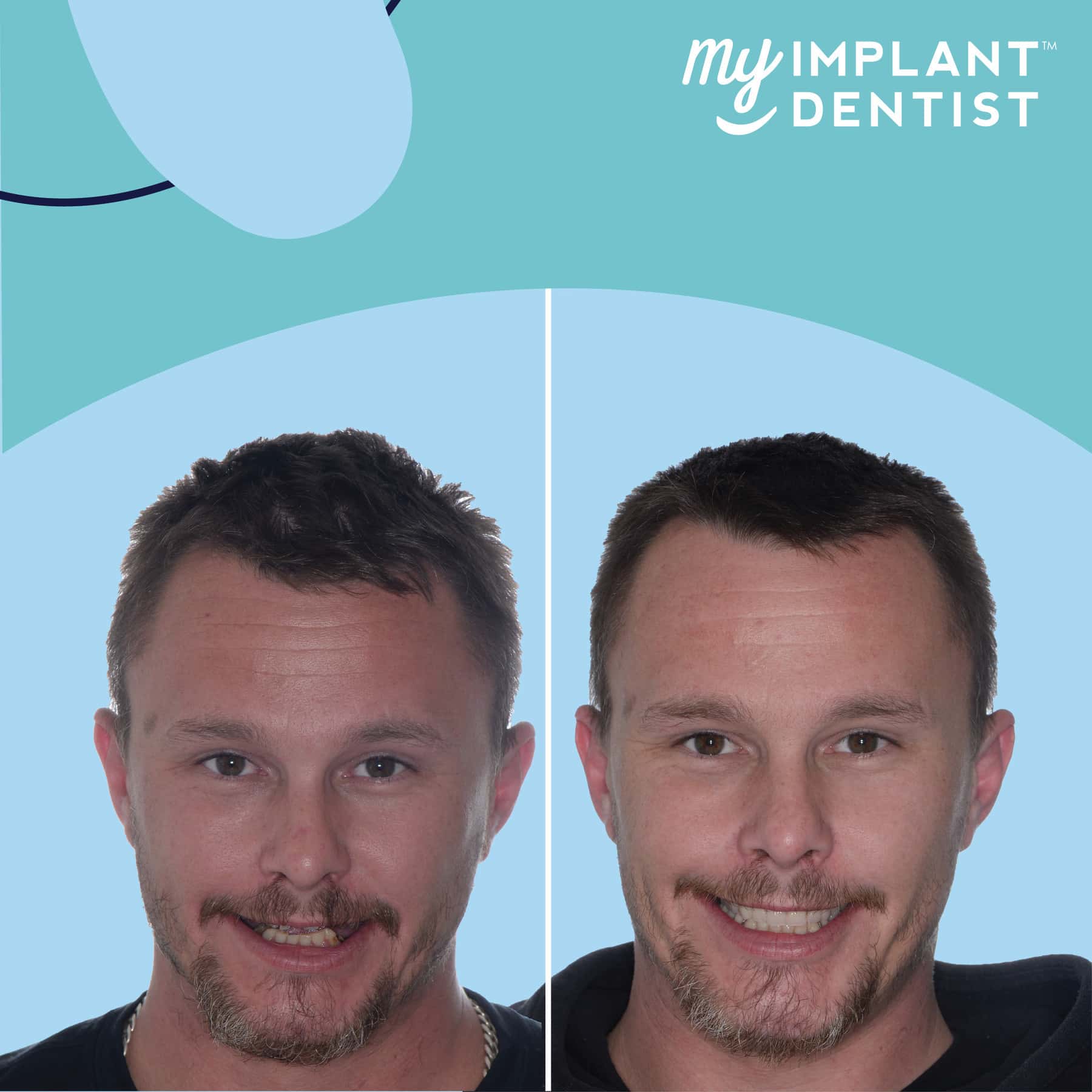 My Implant Dentist Brisbane - Shannon 