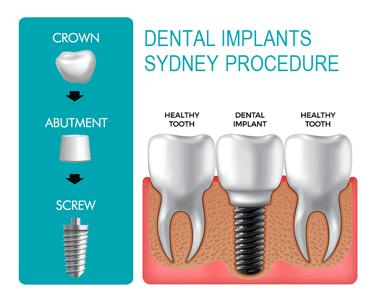 Dental Implants Sydney Procedure