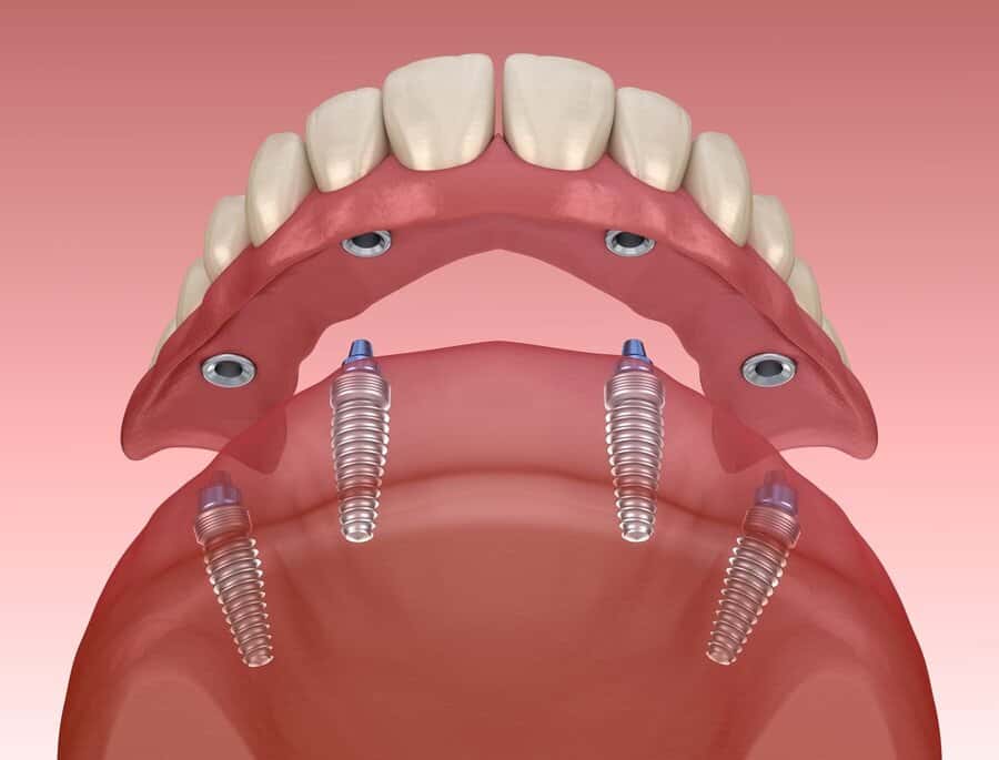 All on 4 Dental Implants - also called full mouth teeth replacement
