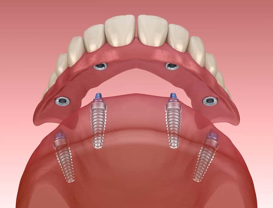 All on 4 Implants treatment