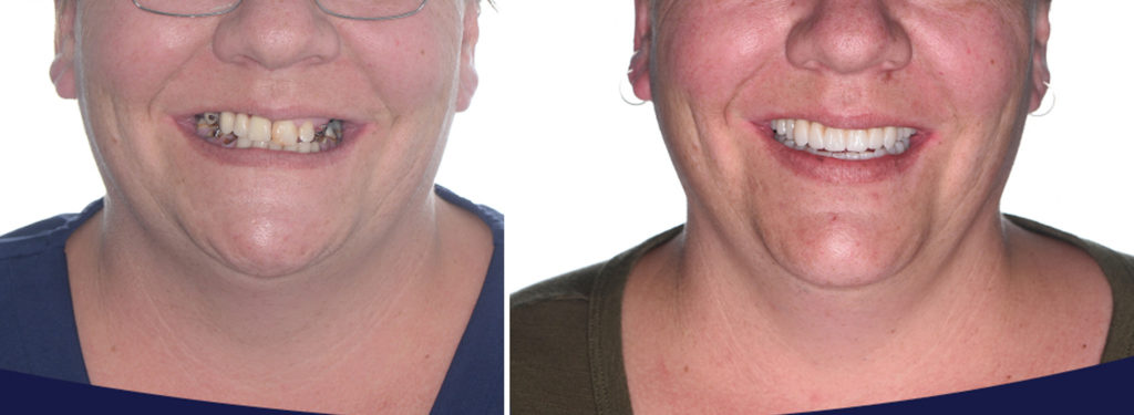 All on 4 Perth - All-on-4 dental implants before and after