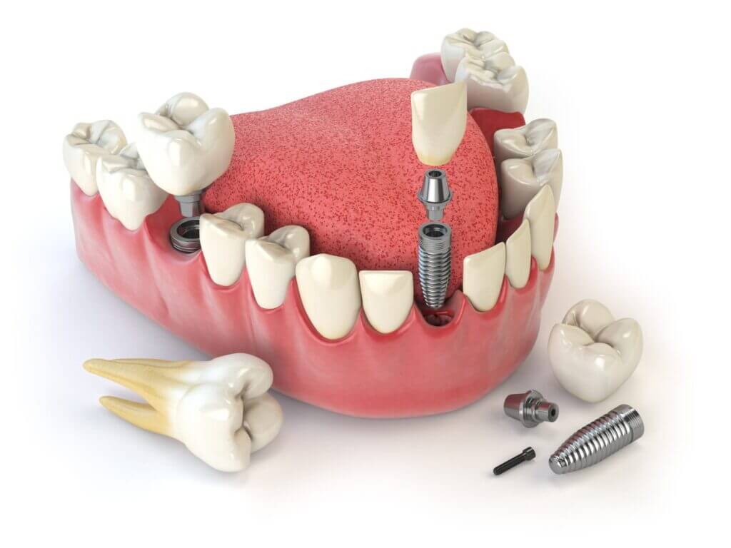 Eating with Implant-Supported All-on-4 Dentures