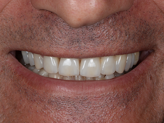 cosmetic dentistry perth dental crown