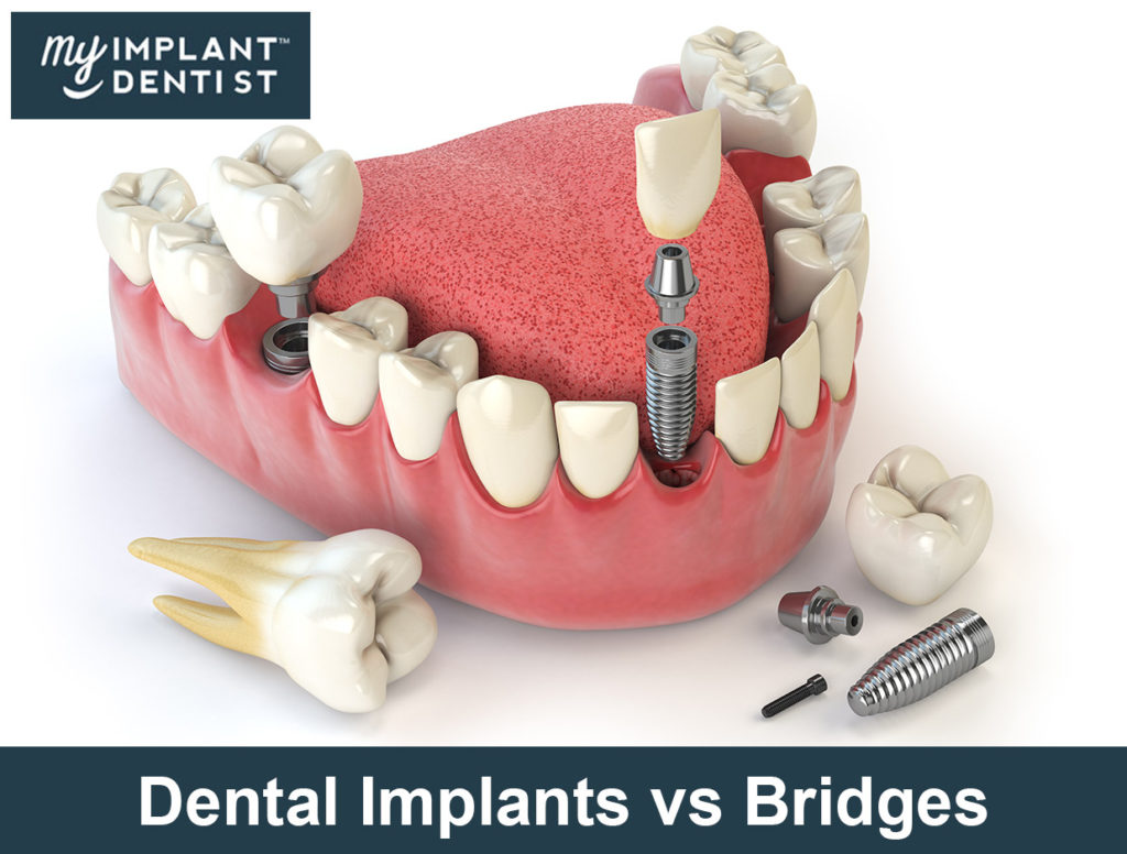 Dental implants vs bridges