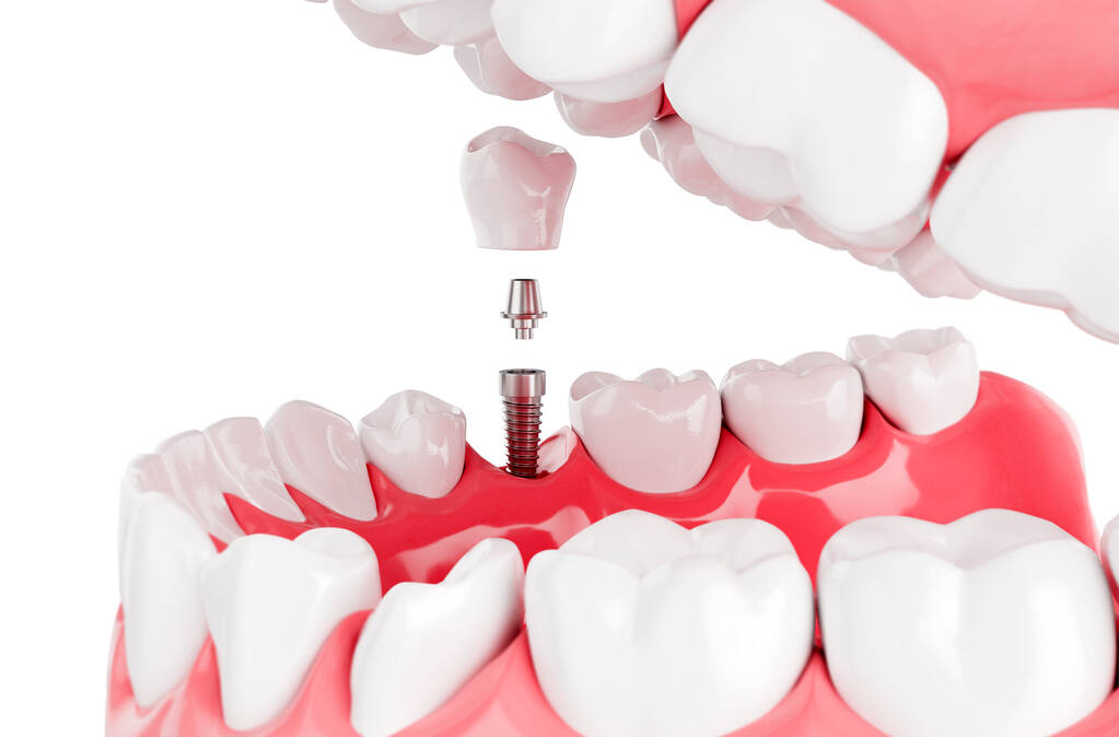 Perth's dental implants literature reviews