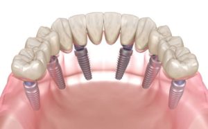 Affordable Dental implants in Perth