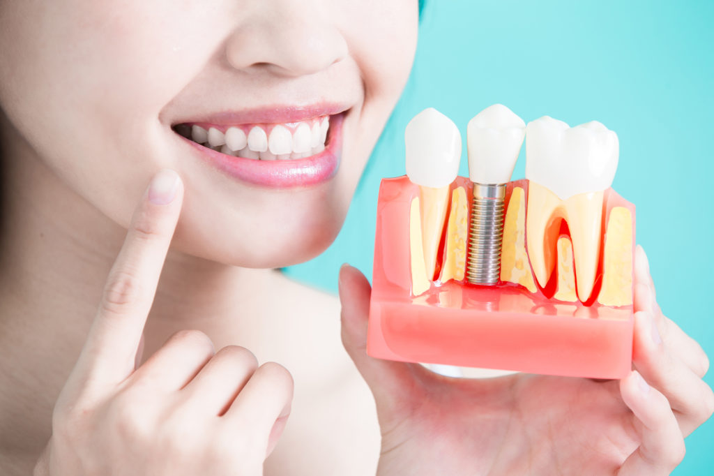 Affordable Dental Implants Cost Australia 