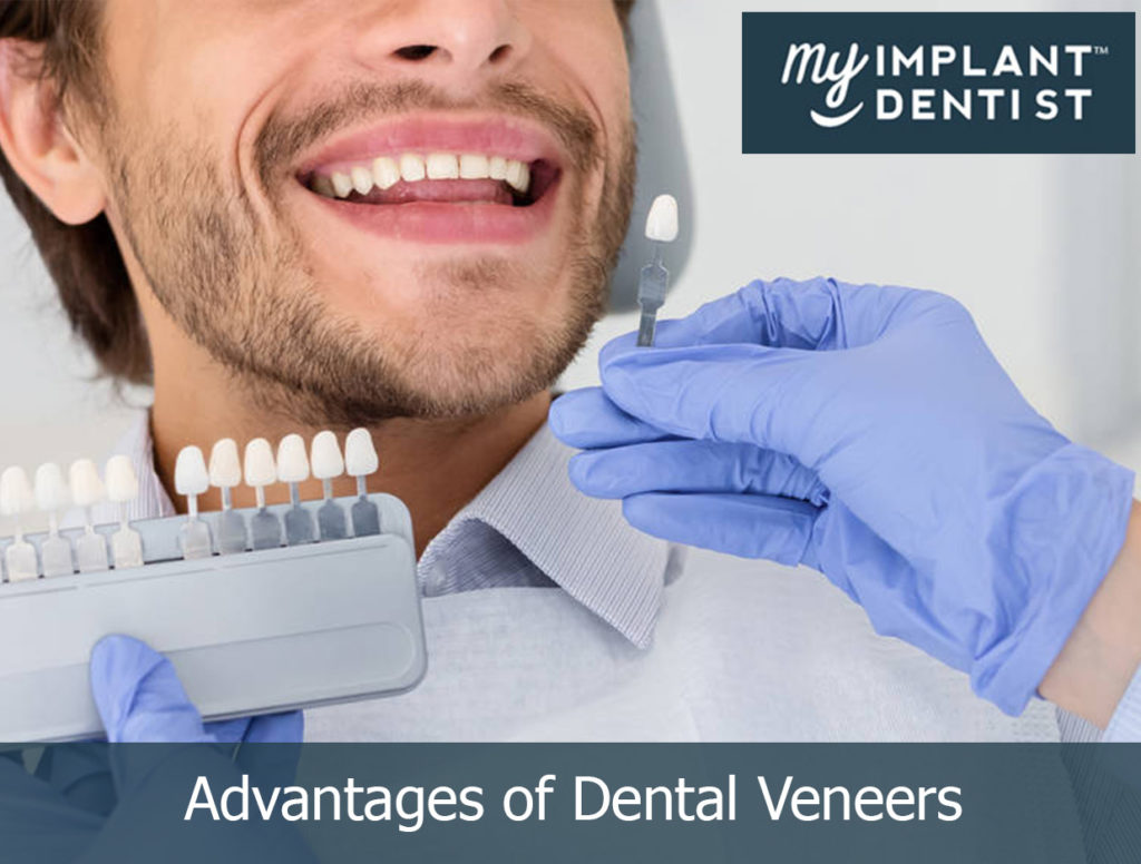 advantages of dental veneers