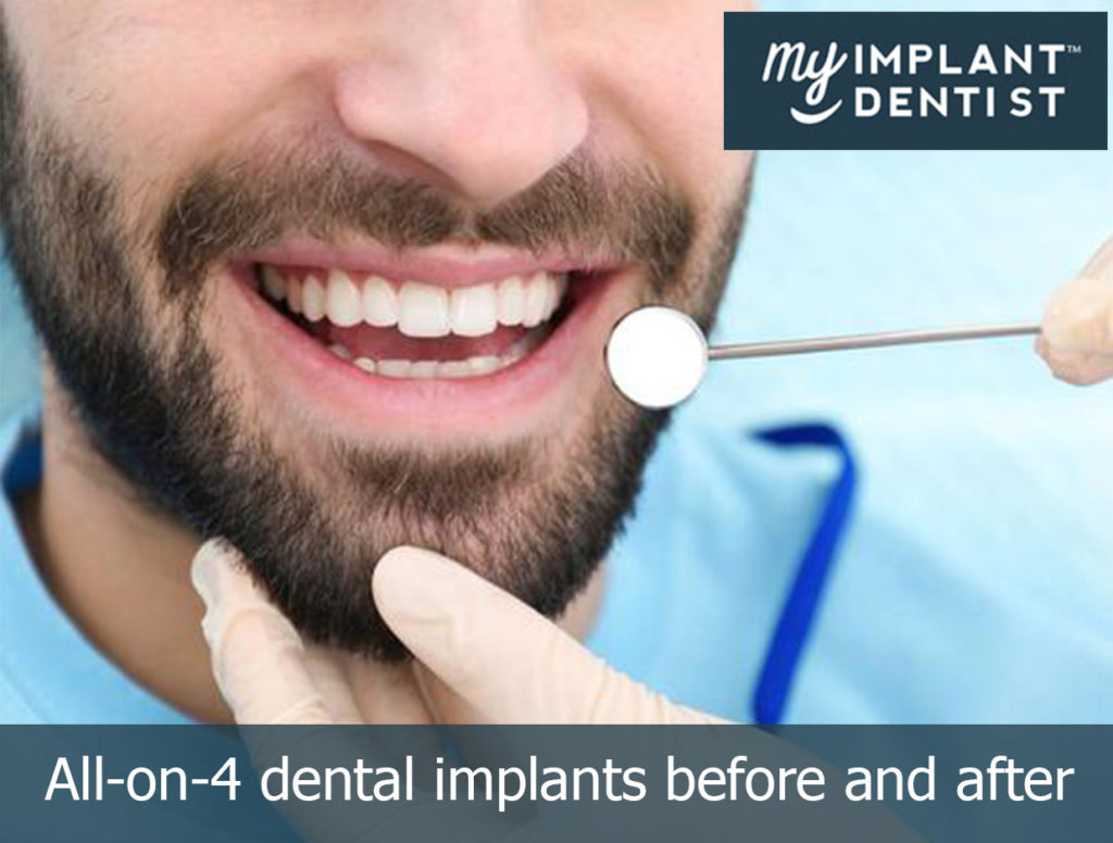 what is all on four dental implant, and how does it work