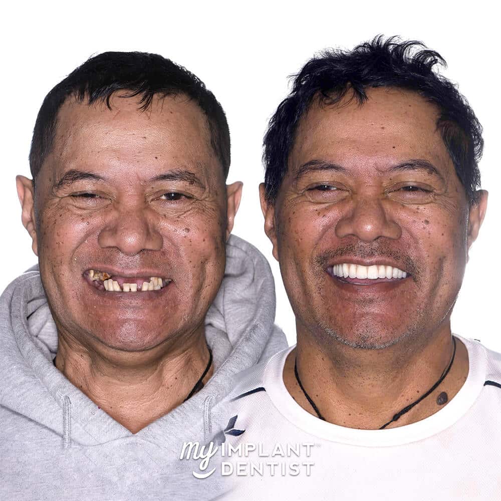 Adam's dental implants before and after photo