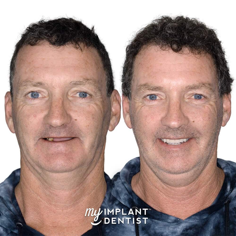 Alan's before and after photo teeth implants treatment