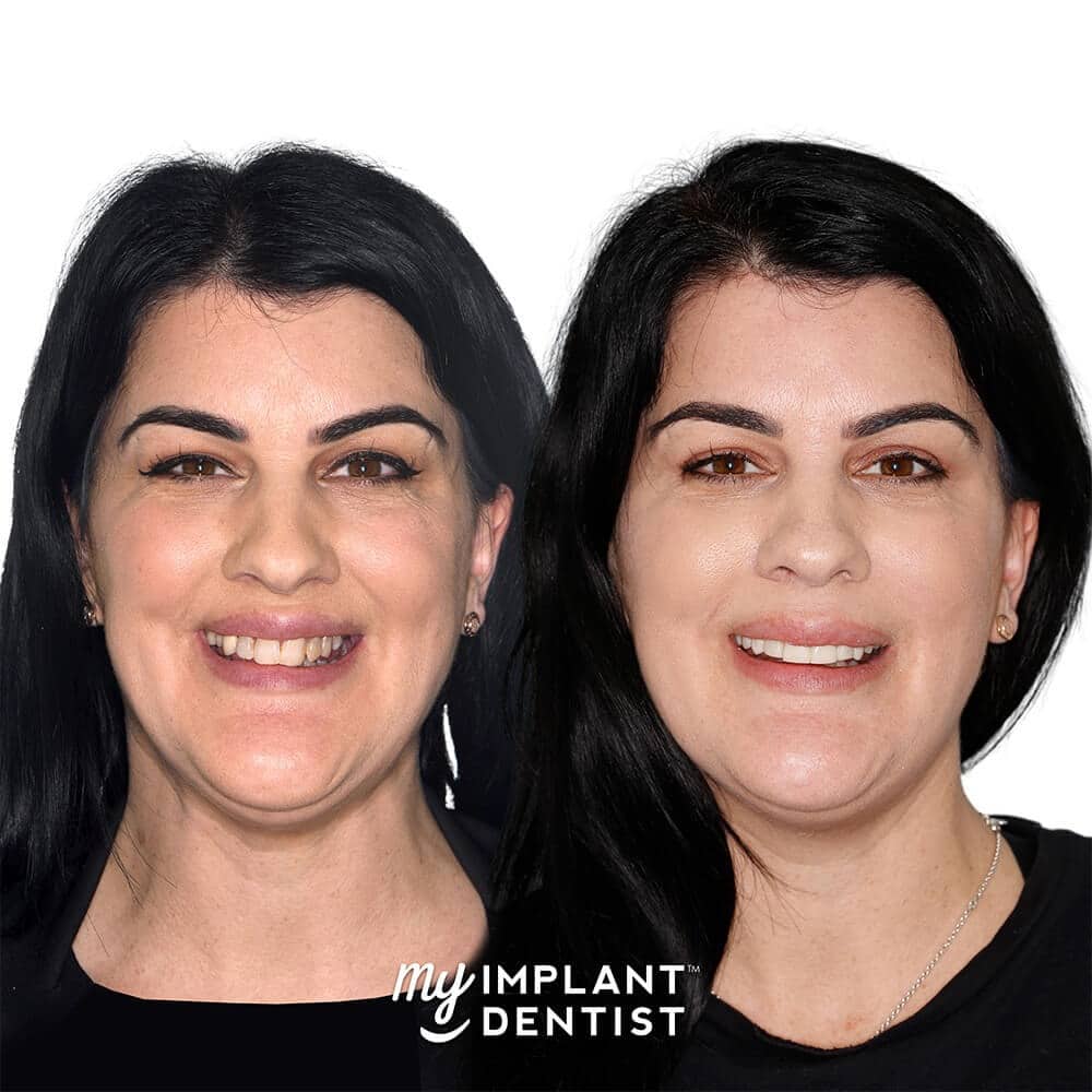 Anita's Before & After Pictures - Dental Implants