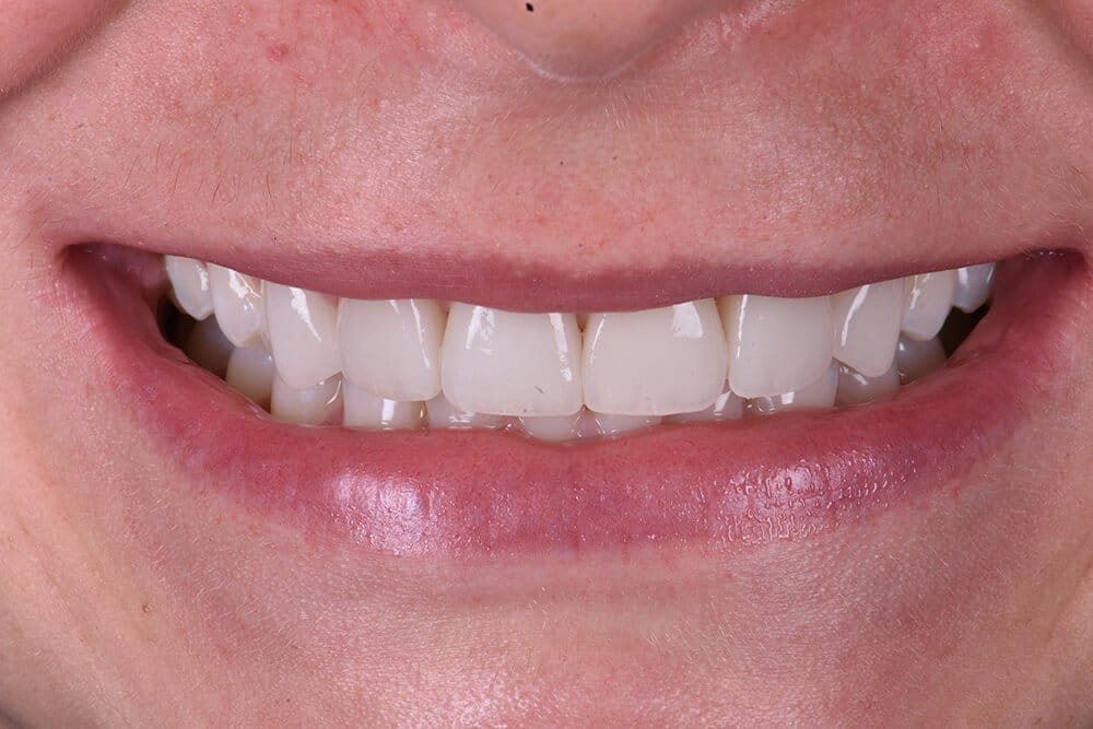 what types of dental veneers are available?
