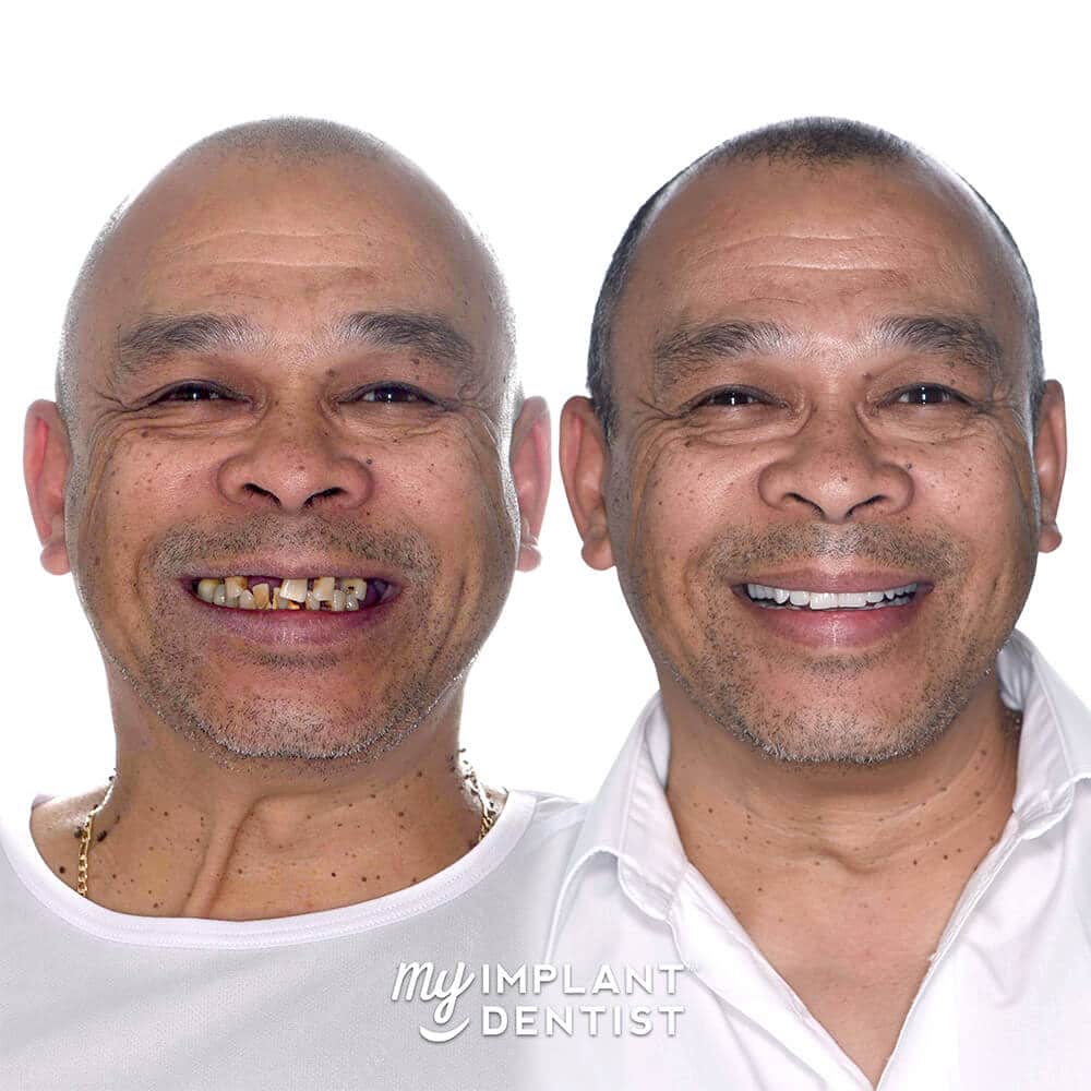 Abubaker's before and after full mouth teeth implants