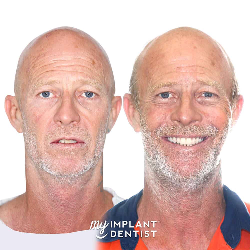 Adrian's Photo before and after dental implants