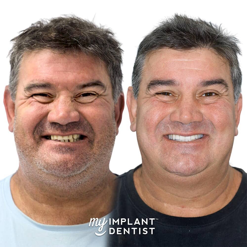 Photo of Ali's Before & After Dental Implants