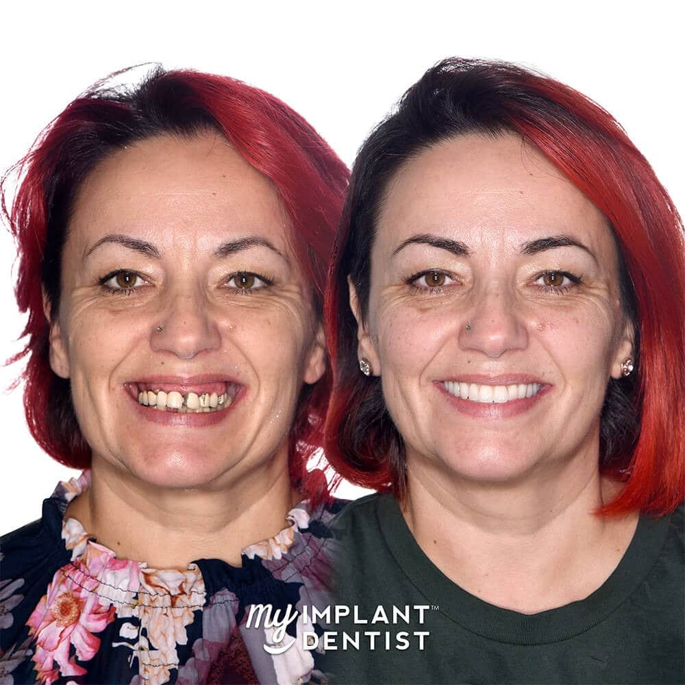 Anna's dental implants before and after images