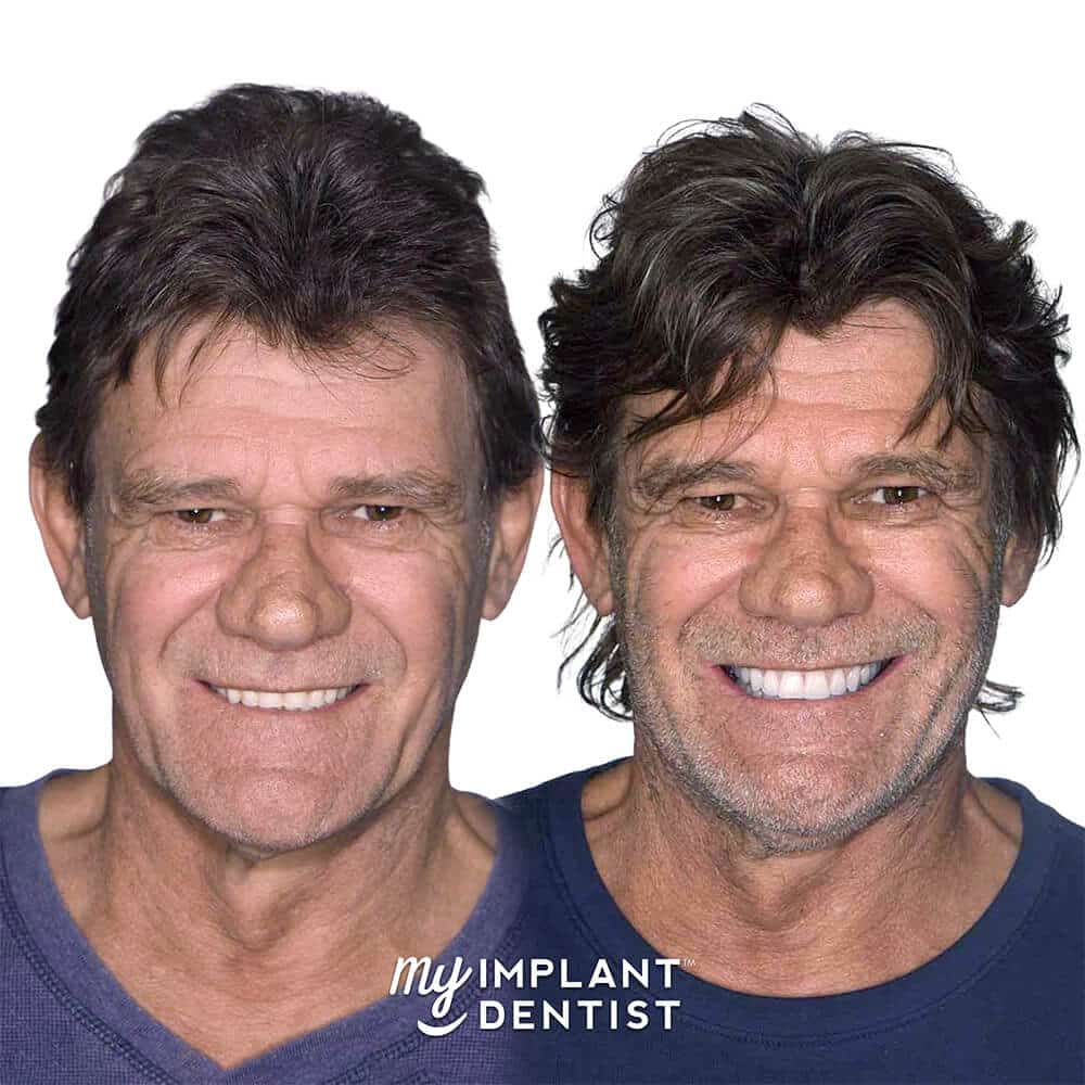 dental implants patient before and after