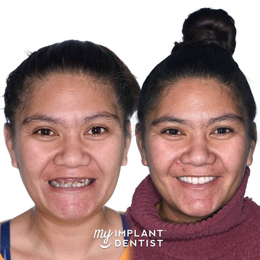 Christine Before and After Dental Implants Perth