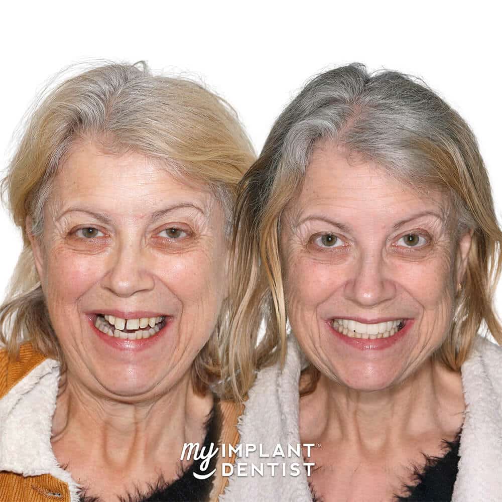 all on 4 dental implants patient before and after