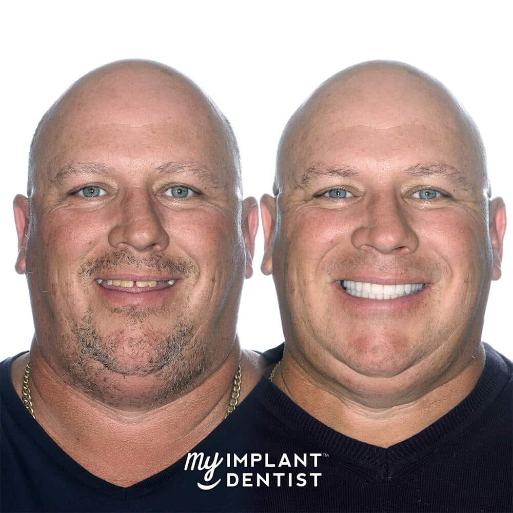 dental implants patient before and after gallery
