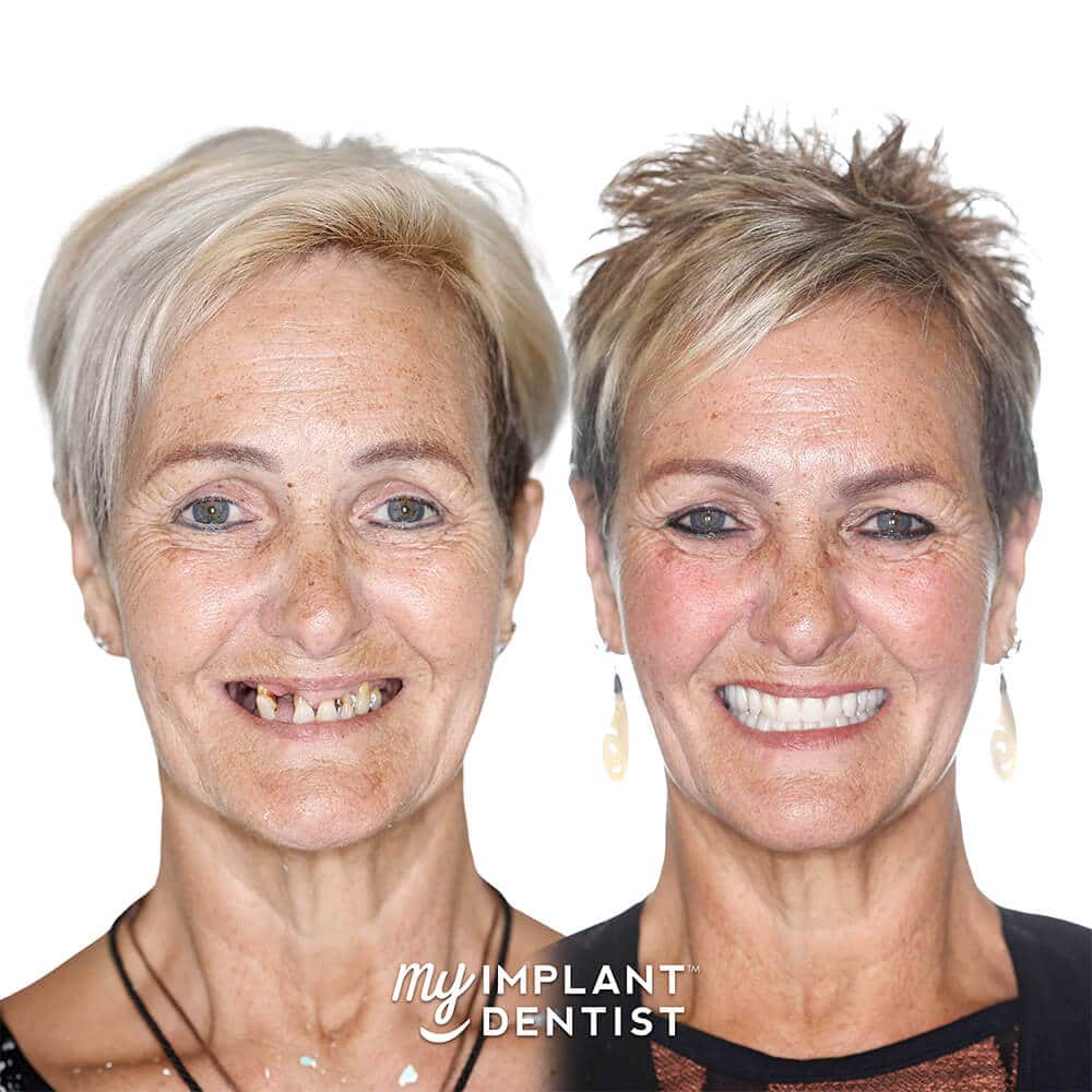 all on 4 dental implants patient before and after smile
