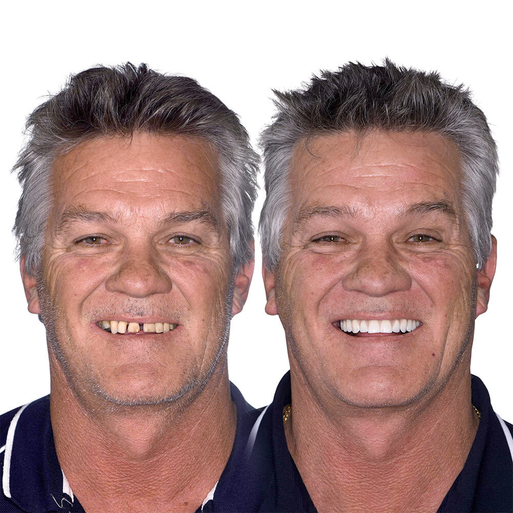 all on 4 dental implants patient before and after gallery