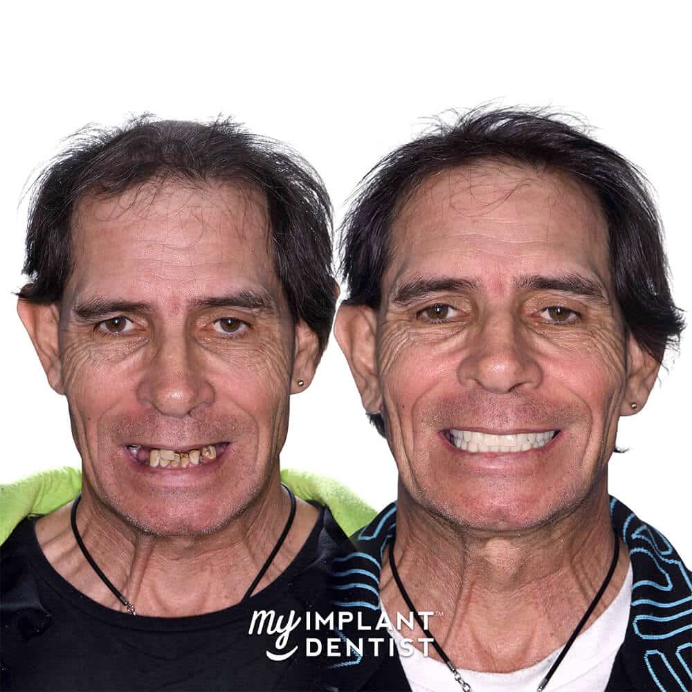 all on 4 dental implants patient before and after