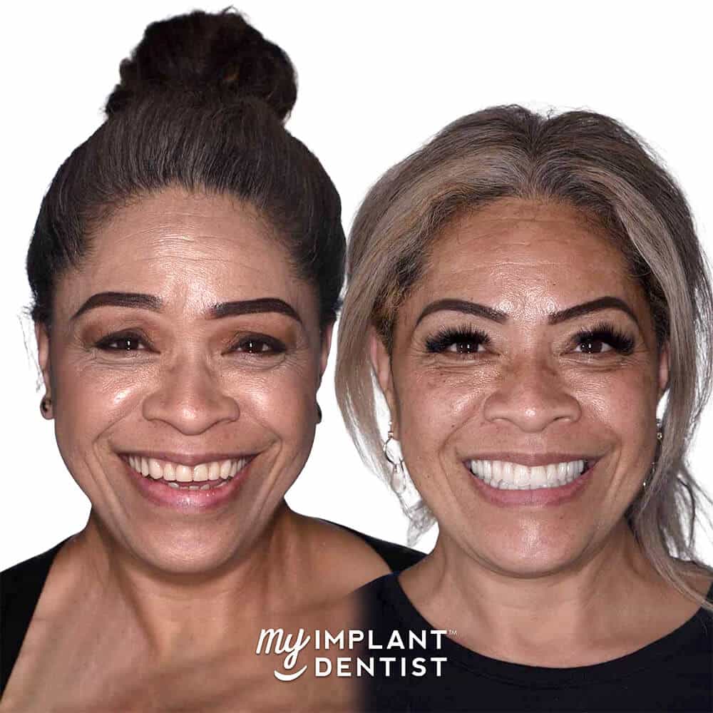 dental implants patient before and after beautiful smile