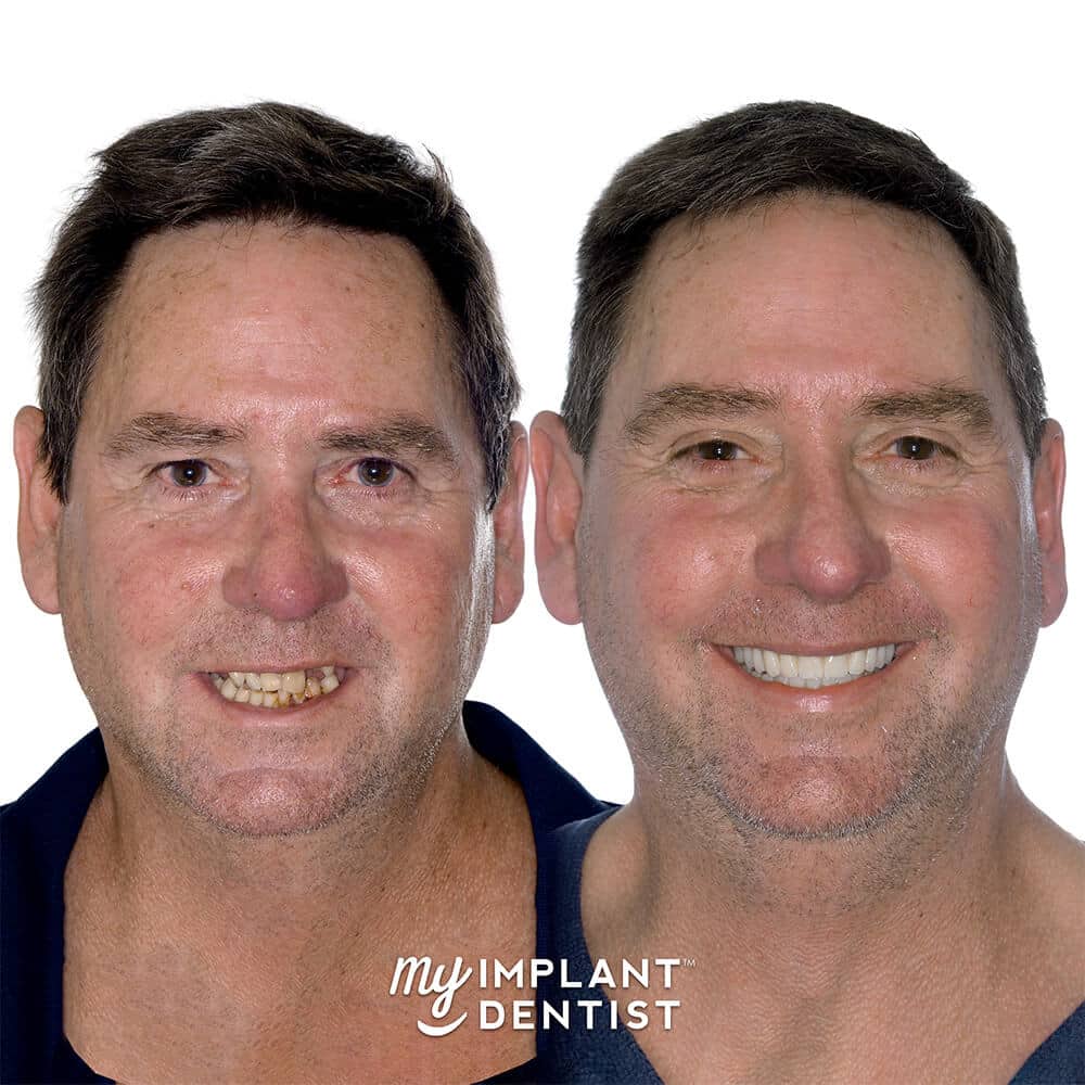 dental implants patient gallery before and after