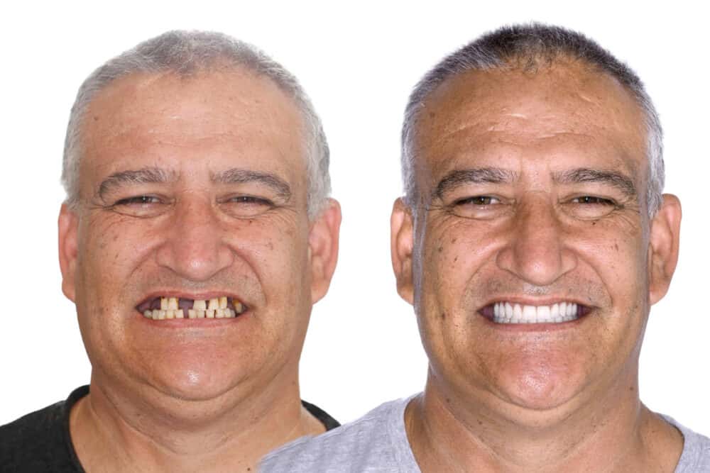 dvantages of All-on-4 implants