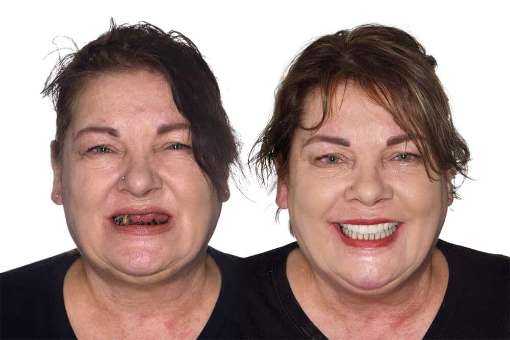 full mouth dental implants patient before and after