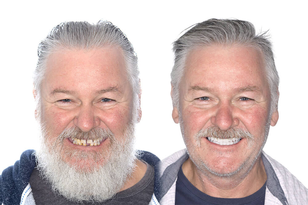 before and after dental implants