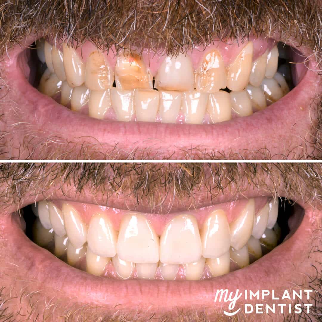 dental implants before and after smile gallery
