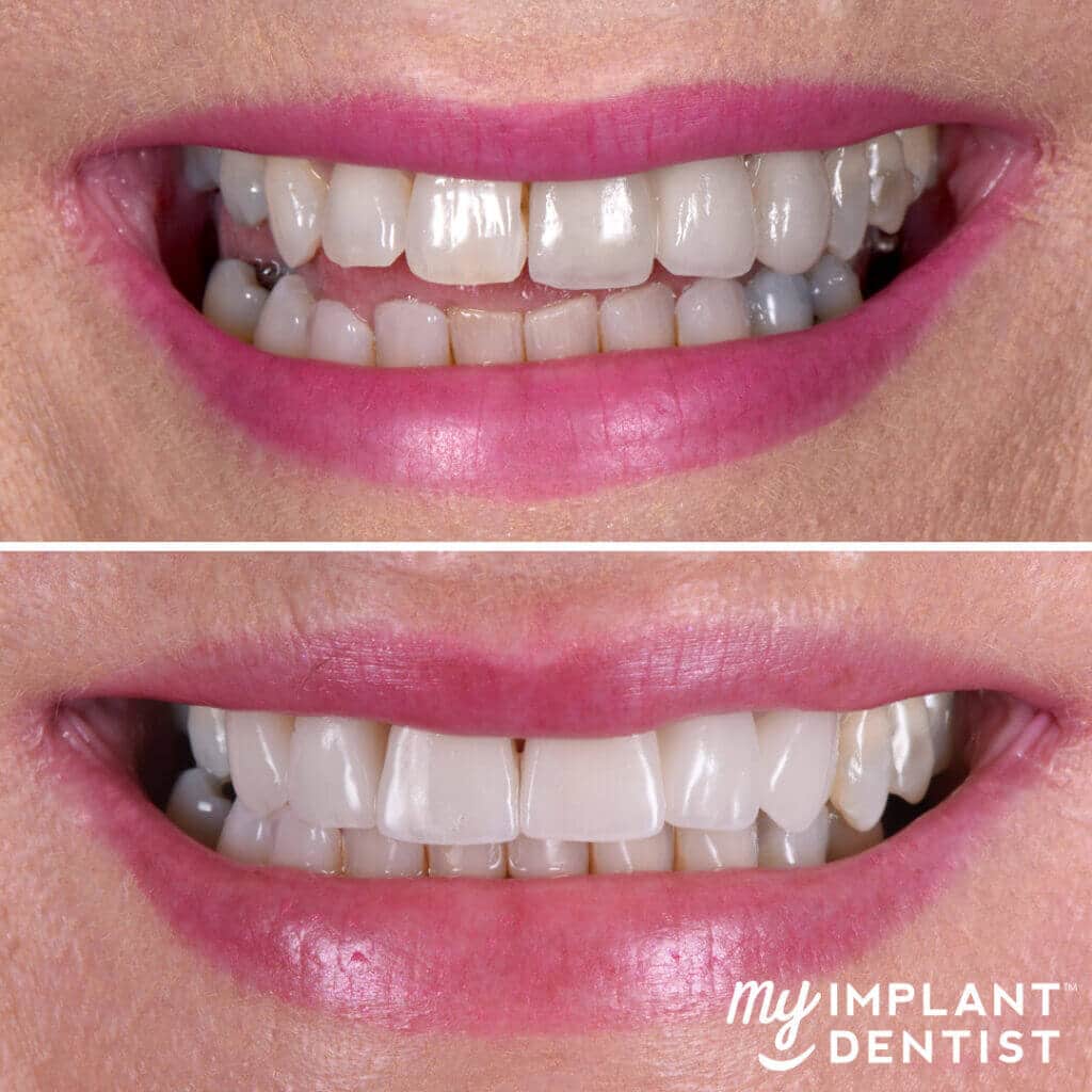 dental implants before and after smile