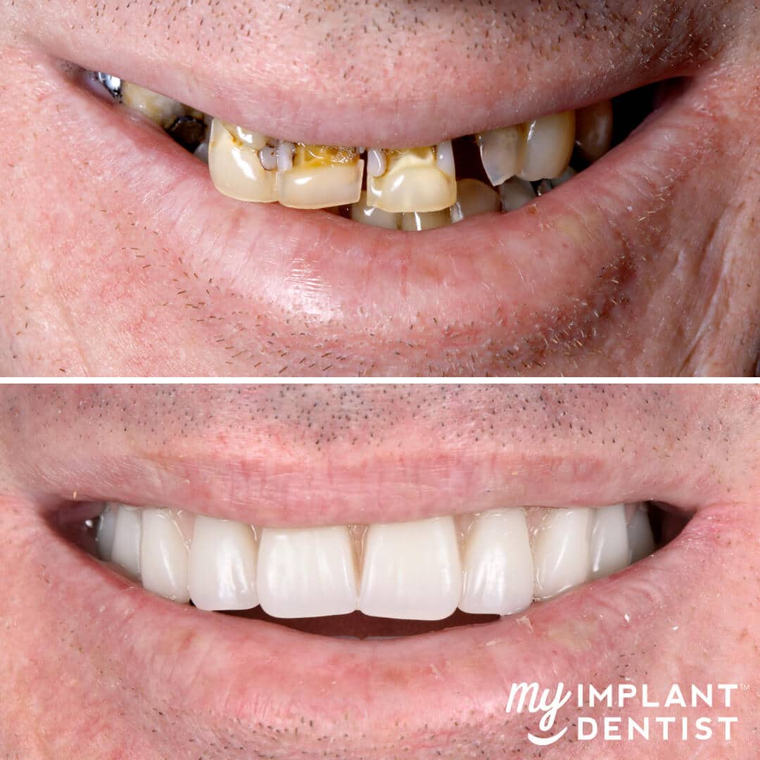 dental implants before and after close-up