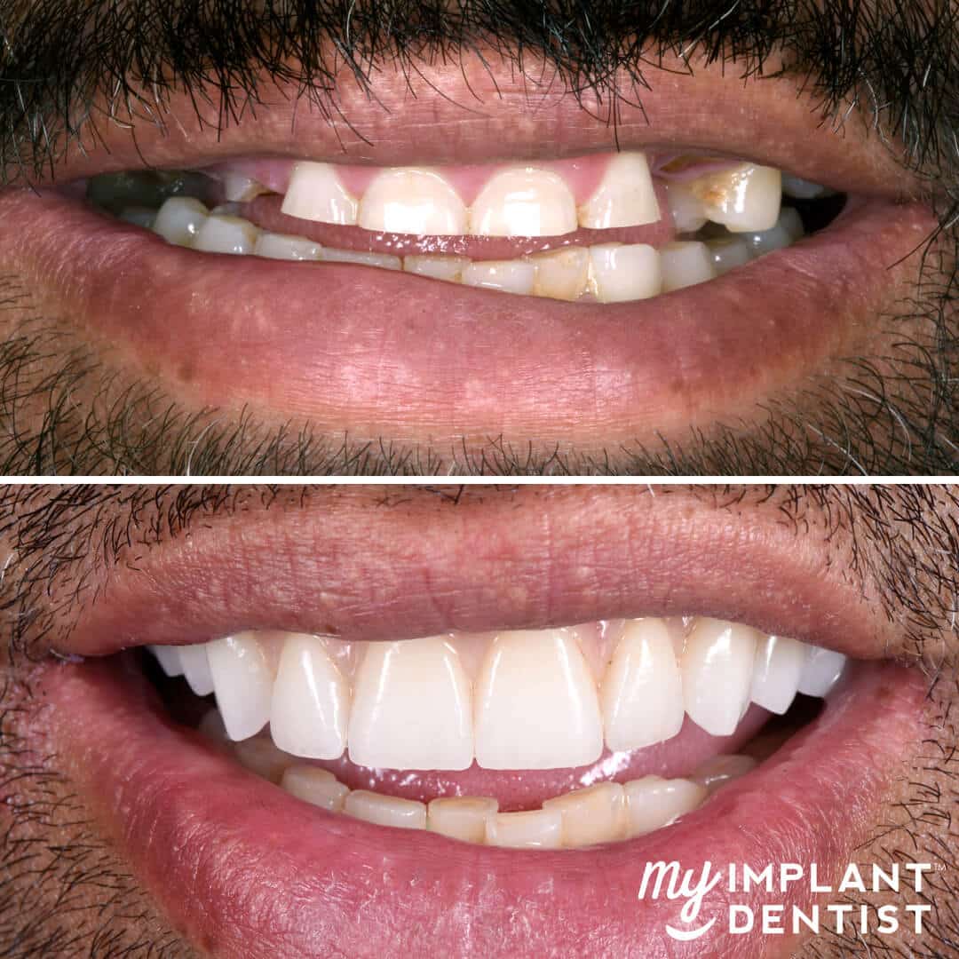 dental implants before and after man's smile