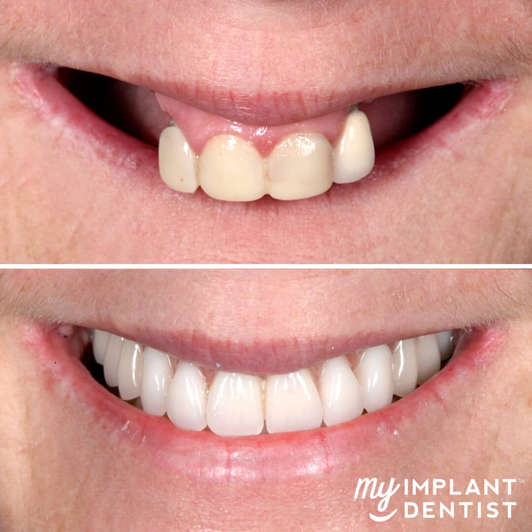 dental implants before and after smile