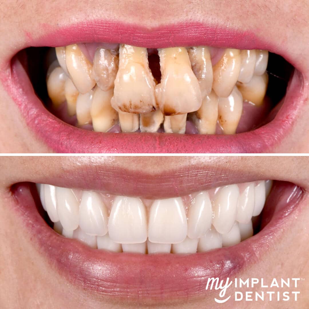 dental implants before and after woman's smile
