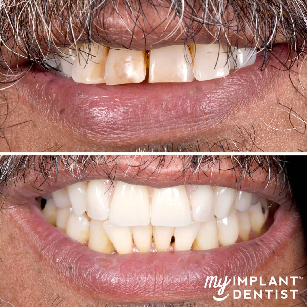 dental implants before and after gallery