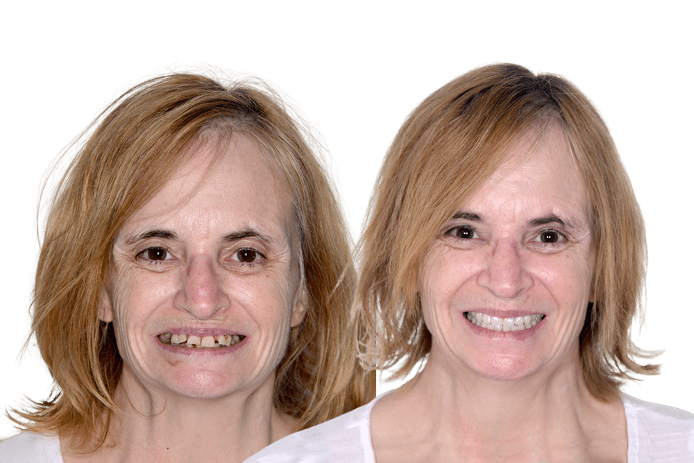 before and after dental implants Michelle