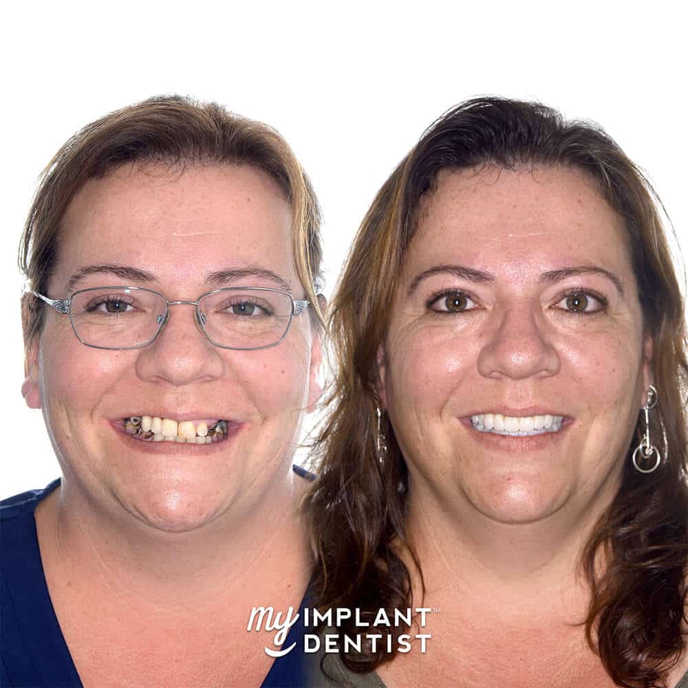 dental implants patient before and after, smiling woman